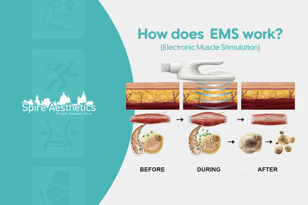 EMS treatment for post pregnancy weight loss treatment Smethwick