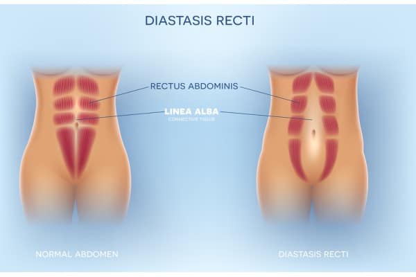 What Non-Surgical Options Are Available for Diastasis Recti Smethwick?