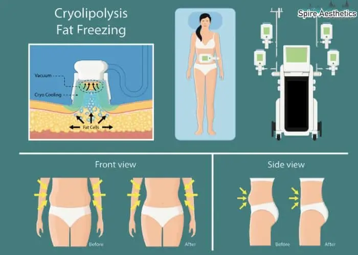 Fat freezing treatment Smethwick benefits for competitions to remove stubborn fat deposits.