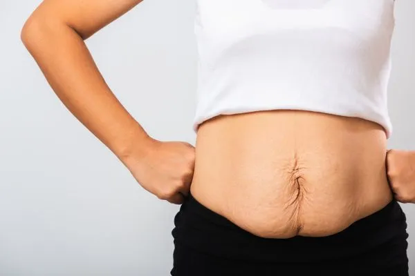 Image of a woman's stomach after weight loss with sagging skin following a gastric band Smethwick