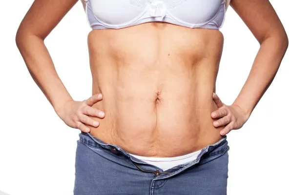 sagging skin on woman's stomach after weight loss injections Smethwick