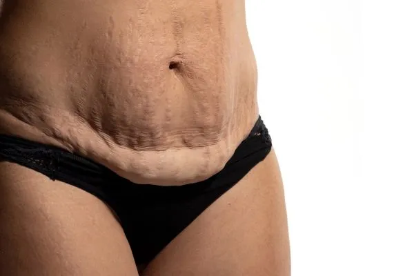 Image of womans stomach after weight loss injections Smethwick showing saggy skin