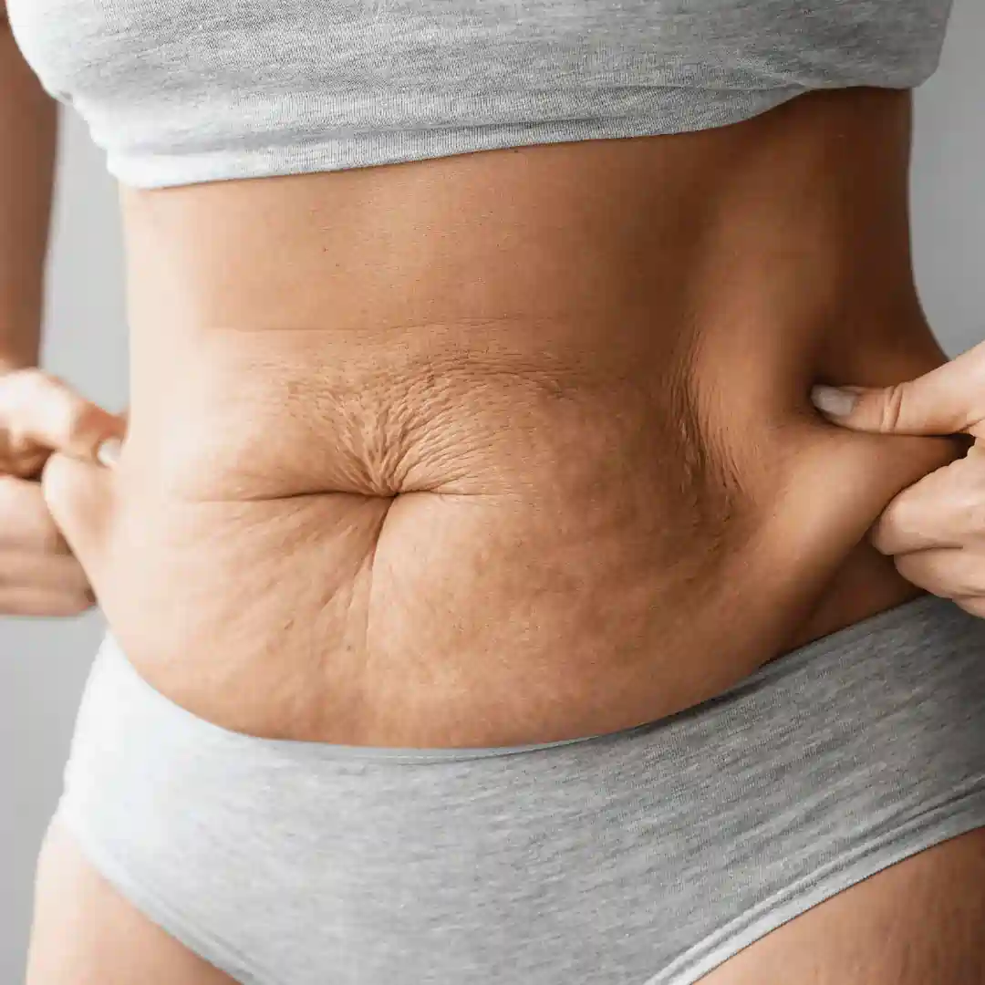 Is It Normal to Have Loose Skin After Pregnancy Smethwick?