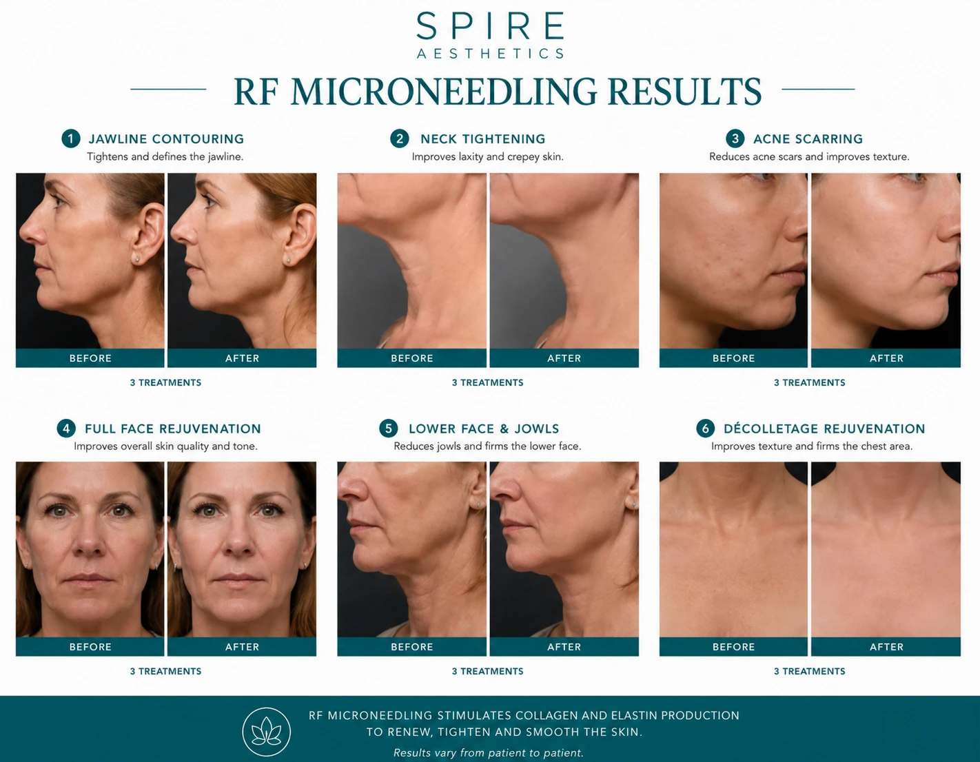 RF Microneedling Skin tightening Smethwick results