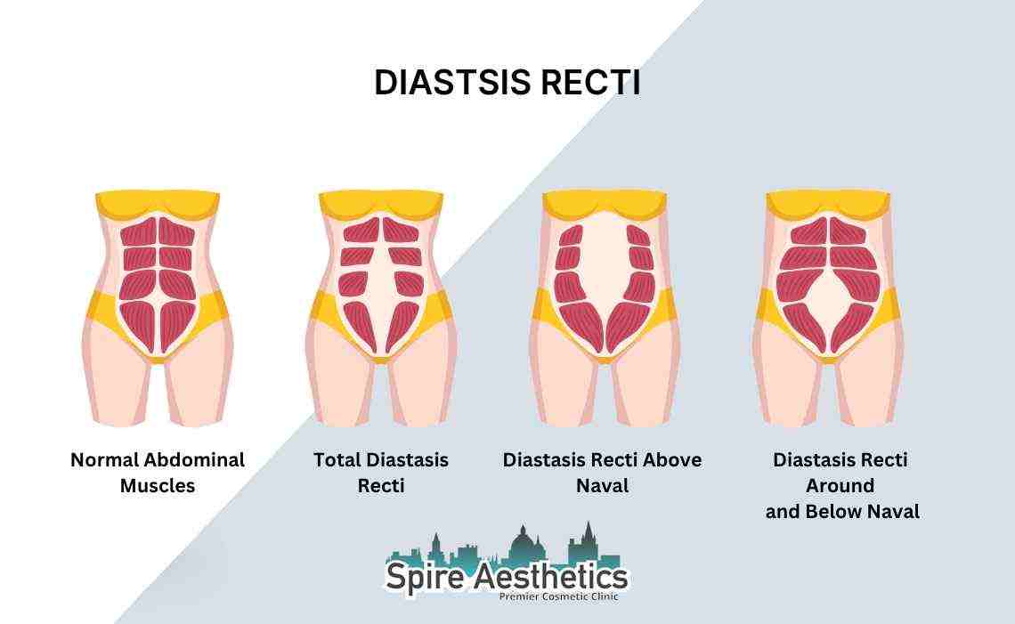 Is Non-Surgical Diastasis Recti Treatment Right for You? Common Concerns Answered Smethwick
